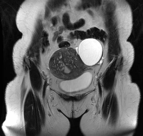 Adenomyosis - wikidoc