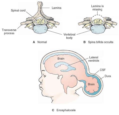 Examples of abnormalities in the development of the brain and spinal cord. (A) The normal ...