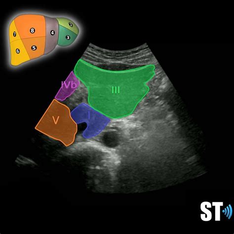 Couinaud’s Liver Segments – Sonographic Tendencies | Segmentation, Diagnostic medical sonography ...