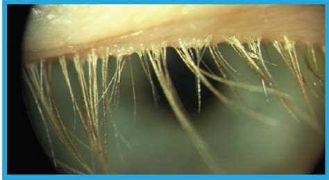 CRSToday | Demodex Blepharitis: Simple Diagnosis, Challenging Treatment