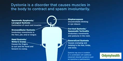 Involuntary Movements Can Be Dystonia. Know All About This Neurological Disorder | OnlyMyHealth