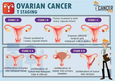 Pin on Ovarian