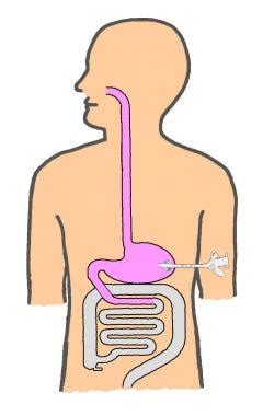 Percutaneous Gastrostomy and Jejunostomy Technique: Approach Considerations, Percutaneous Access ...