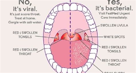 How Do You Get Strep Throat?