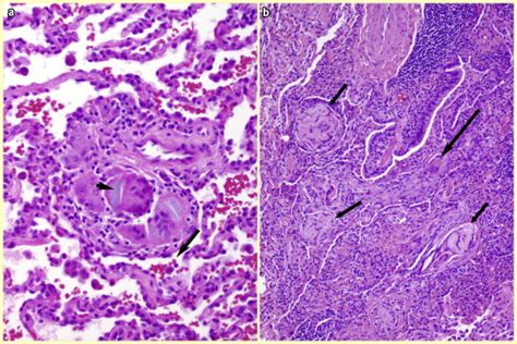 Pulmonary granulomas: differential diagnosis, histologic features and algorithmic approach ...