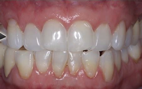 Can receding gums be reversed?