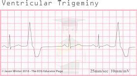 ECG Educator Blog : Ventricular Ectopics | Cardiac nursing, Education ...