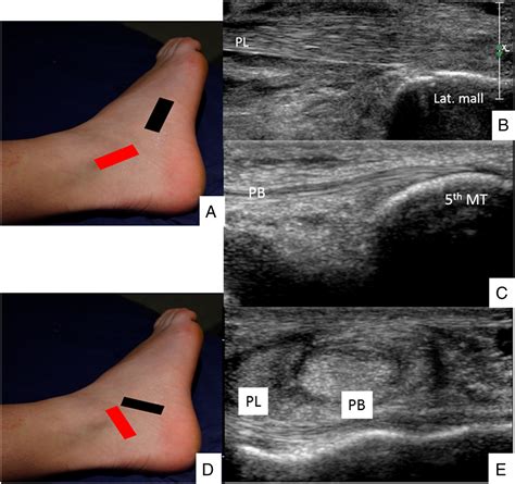 Sonography of the ankle: The lateral ankle and ankle sprains - McKiernan - 2017 - Sonography ...