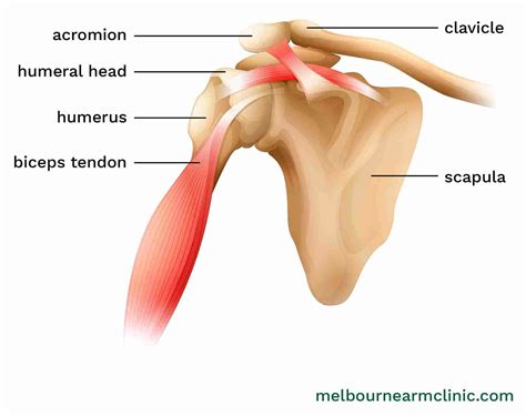 Bicep Tendon Tear at the Shoulder – Melbourne Arm Clinic