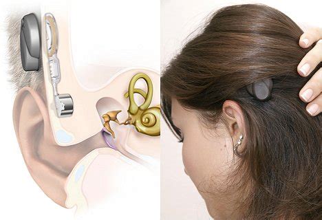 Bone conduction Implant Effect on Tinnitus in Patients with Hearing Loss : r/tinnitusresearch