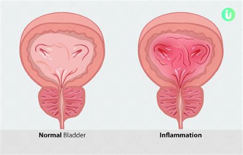 Women’s Health : Interstitial Cystitis….Cure - HOME TIMES