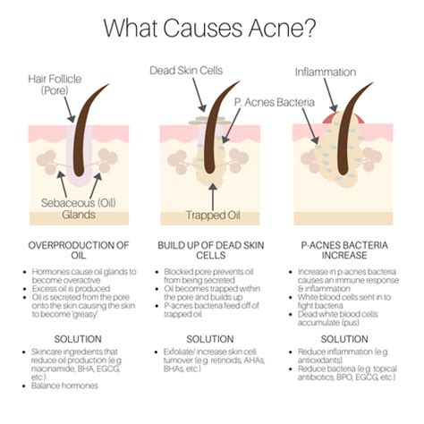 Acne Causes