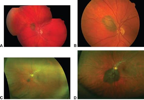 Malignant transformation of choroidal nevus to melanoma - American Academy of Ophthalmology