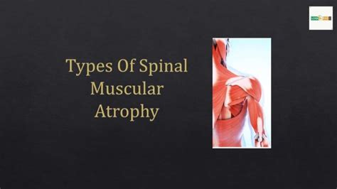 Spinal Muscular Atrophy Types | PPT