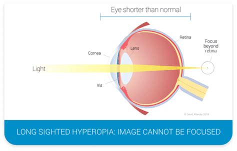 What Is Hyperopia? | Focus Clinics