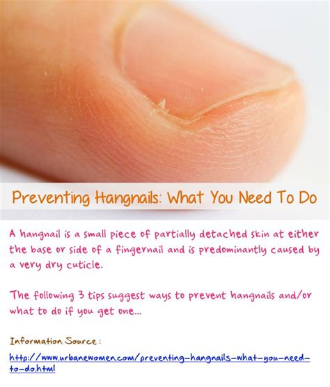 Preventing Hangnails: What You Need To Do