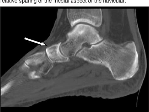 Answer to case of the month #129. Mueller-Weiss syndrome. | Semantic ...