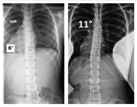 Mild Scoliosis X Ray