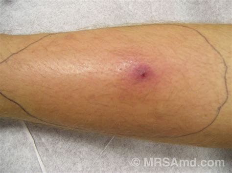 MRSA Pictures / Staph Infection Pictures/Graphic Images – MRSA MD