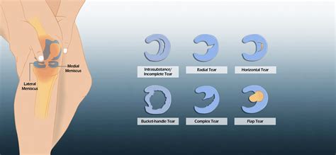 Meniscus Tear: Causes, Symptoms & Treatment