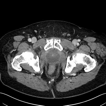 Large prostatic abscess | Radiology Case | Radiopaedia.org