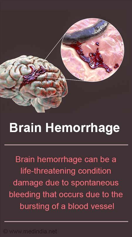 Brain Hemorrhage Intracranial Hemorrhage, 57% OFF