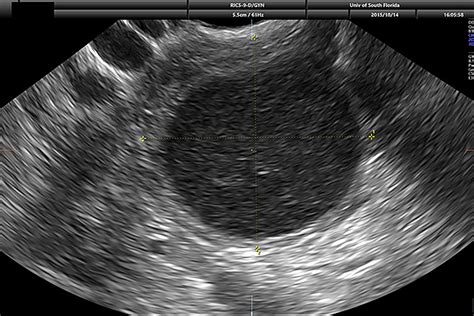 Ovarian Cyst On Ultrasound Image