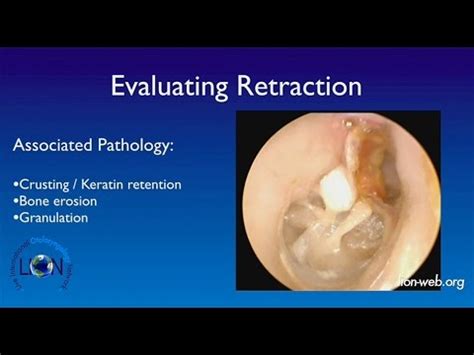 The 18th Otology Course Lecture Tympanic membrane retraction Neil ...