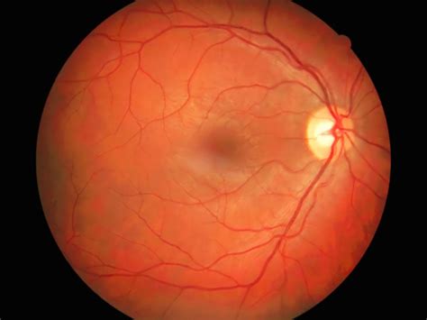 Fluorescein Angiography: Purpose, Procedure and Results