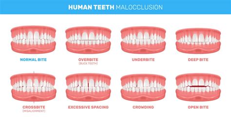 Overbite vs. Underbite: Causes, Differences & Solutions