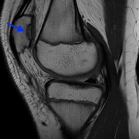 Knee Osteochondritis Dissecans (OCD) Drilling