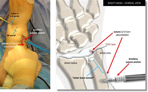 2 5 Mm Knotless Suture Anchor | Arthrex Inc | Bioz