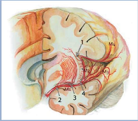 Figure 1 from [Surgical anatomy of the insular cortex]. - Semantic Scholar