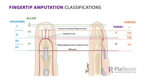 Fingertip Amputation Classifications