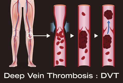 Travel and Deep Vein Thrombosis (DVT) - Health Beat