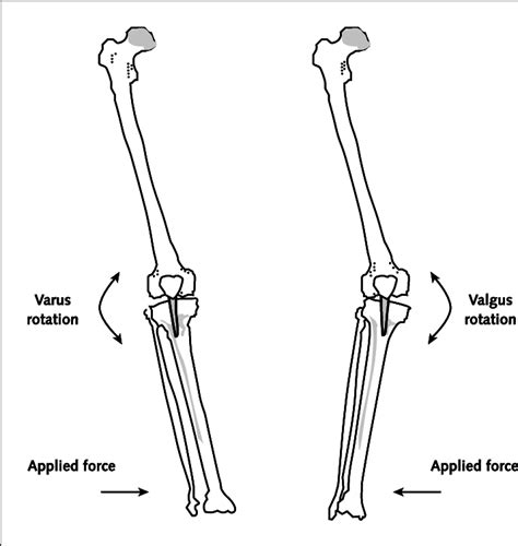 Direction of force application and the resulting motion at the knee in... | Download Scientific ...