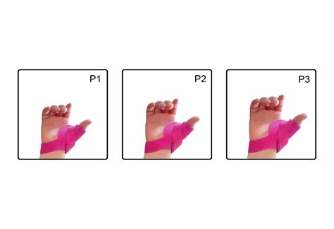 McKie Thumb Splint Bundles Pediatric Sizes - P1-P2-P3 / Left / Royal Blue | Thumb splint ...