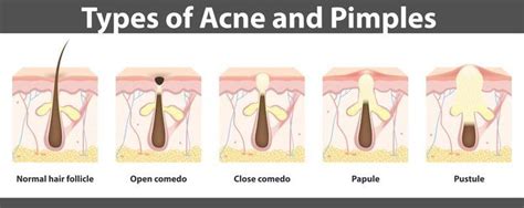 Types of Acne & Comedones: How to Treat Acne in Kenya # ...