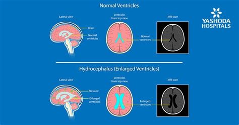 Hydrocephalus: Types, Symptoms, Causes, Risk Factors, Diagnosis and Treatment