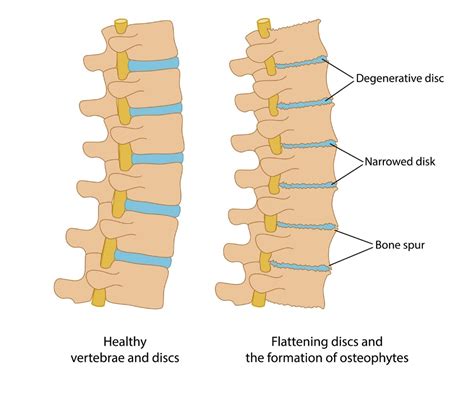 Degenerative Disc In Thoracic Spine