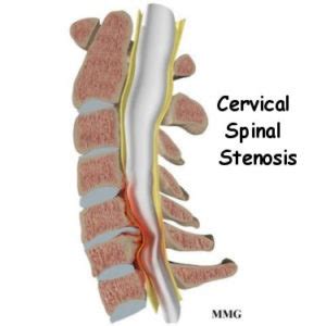 Cervical Stenosis | Condition | Antonio Webb.MD