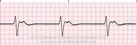 Idioventricular Rhythm ECG Interpretation with Sample Strip