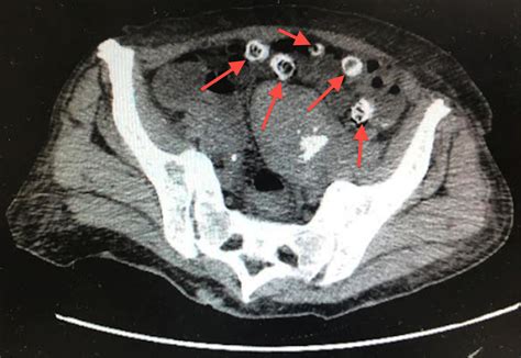 Diverticulitis On Ct Scan