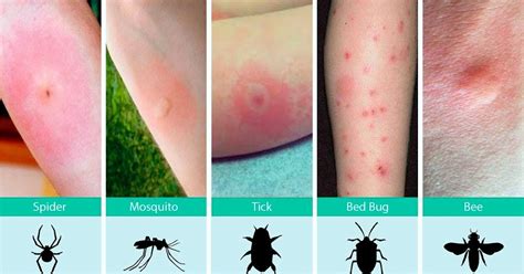 The Health Website : Insect Bites and Stings