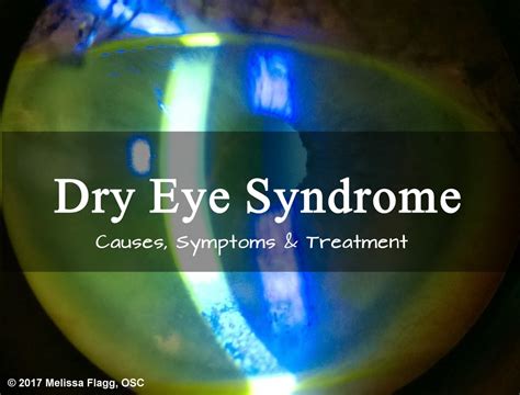 Symptoms, Causes, and Treatment for Severe Dry Eye Syndrome | HealDove