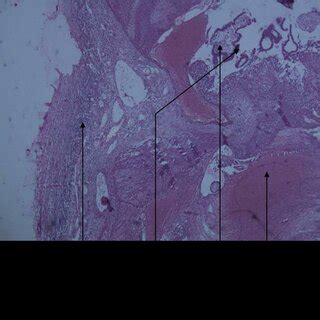 Histopathology of ovarian ectopic pregnancy. | Download Scientific Diagram