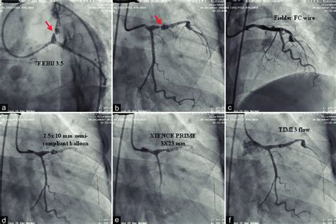 Fluoroscopic images (a-f) of primary angioplasty and stenting,... | Download Scientific Diagram