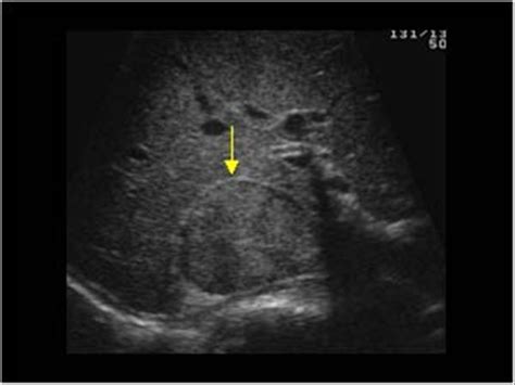 Abdomen and retroperitoneum | 1.10 Adrenal glands : Case 1.10.3 ...