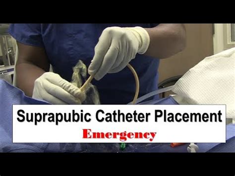 Suprapubic Catheter Placement #2 - VidoEmo - Emotional Video Unity