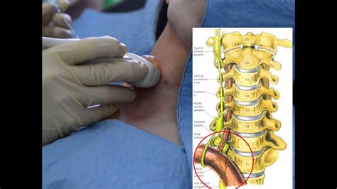 Ganglion Nerve Block